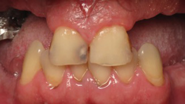 La couronne dentaire en 3 questions - Dentisterie Hanok